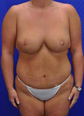 Body, Arm and Thigh Lifts: Case B20 After