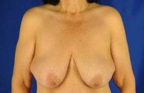 BREAST LIFTS: CASE B3 Before