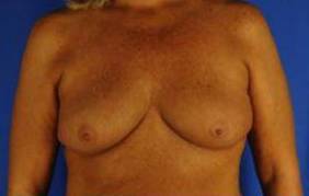 Breast Lifts: Case B1 Before