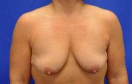 BREAST LIFTS: CASE B4 Before