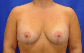 BREAST LIFTS: CASE B4 After