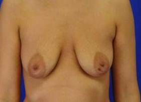 BREAST LIFTS: CASE B7 Before