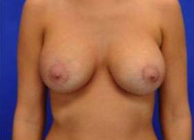 BREAST LIFTS: CASE B7 After