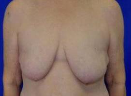 BREAST LIFTS: CASE B10 Before