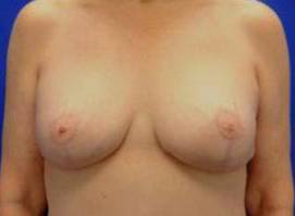 BREAST LIFTS: CASE B10 After