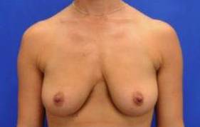 BREAST LIFTS: CASE B11 Before