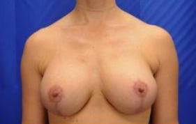 BREAST LIFTS: CASE B11 After