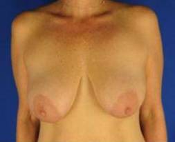BREAST LIFTS: CASE B12 Before