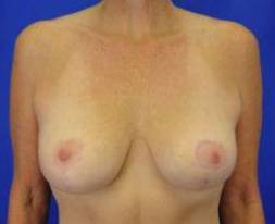 BREAST LIFTS: CASE B12 After