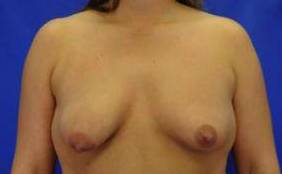 BREAST LIFTS: CASE B14 Before