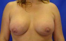 BREAST LIFTS: CASE B14 After