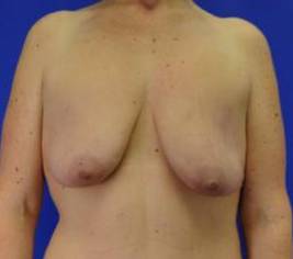 BREAST LIFTS: CASE B15 Before
