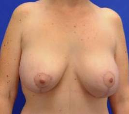 BREAST LIFTS: CASE B15 After