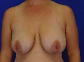 BREAST LIFTS: CASE B16 Before
