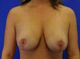 BREAST LIFTS: CASE B16 After
