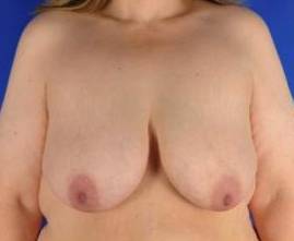 BREAST LIFTS: CASE B18 Before