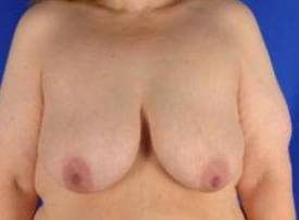 BREAST LIFTS: CASE B19 Before
