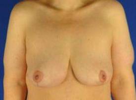BREAST LIFTS: CASE B19 After