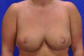 BREAST LIFTS: CASE B20 After