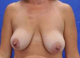 BREAST LIFTS: CASE B21 Before