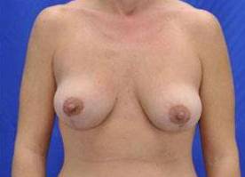 BREAST LIFTS: CASE B21 After