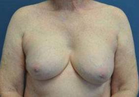 BREAST LIFTS: CASE C6 Before