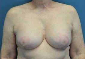 BREAST LIFTS: CASE C6 After