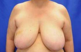BREAST RECONSTRUCTION FOR LUMPECTOMY: CASE N2 Before