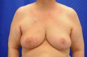 BREAST RECONSTRUCTION FOR LUMPECTOMY: CASE N2 After