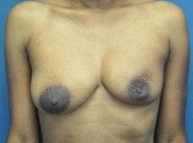 BREAST RECONSTRUCTION FOR LUMPECTOMY: CASE L23 Before
