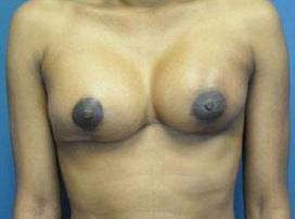 BREAST RECONSTRUCTION FOR LUMPECTOMY: CASE L23 After