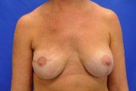 BREAST RECONSTRUCTION WITH IMPLANTS: CASE L1 After