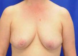 BREAST RECONSTRUCTION WITH IMPLANTS: CASE L2 Before