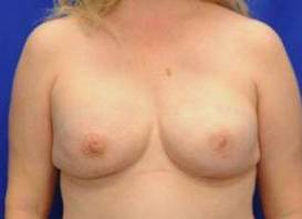 BREAST RECONSTRUCTION WITH IMPLANTS: CASE L2 After