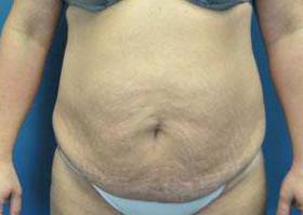 Liposuction: Case I14 Before