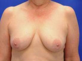 BREAST RECONSTRUCTION WITH IMPLANTS: CASE L3 Before