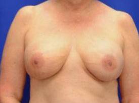 BREAST RECONSTRUCTION WITH IMPLANTS: CASE L3 After