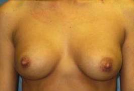 BREAST RECONSTRUCTION WITH IMPLANTS: CASE L4 Before