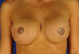 BREAST RECONSTRUCTION WITH IMPLANTS: CASE L4 After
