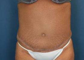 Liposuction: Case I14 After