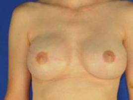 BREAST RECONSTRUCTION WITH IMPLANTS: CASE L7 After