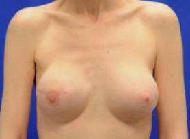 BREAST RECONSTRUCTION WITH IMPLANTS: CASE L8 After