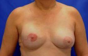 BREAST RECONSTRUCTION WITH IMPLANTS: CASE L10 After