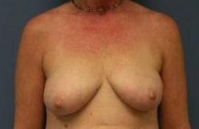BREAST RECONSTRUCTION WITH IMPLANTS: CASE L11 Before