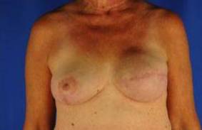 BREAST RECONSTRUCTION WITH IMPLANTS: CASE L11 After