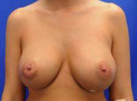 BREAST RECONSTRUCTION WITH IMPLANTS: CASE L12 Before