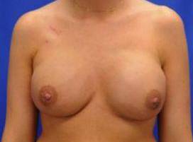 BREAST RECONSTRUCTION WITH IMPLANTS: CASE L12 After