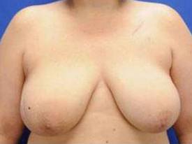 BREAST RECONSTRUCTION WITH IMPLANTS: CASE L13 Before