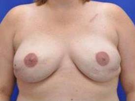 BREAST RECONSTRUCTION WITH IMPLANTS: CASE L13 After