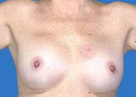 BREAST RECONSTRUCTION WITH IMPLANTS: CASE L14 Before